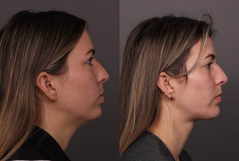 Before Image: Deep Neck Contouring with Chin Implant - 