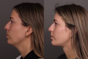 Before Image: Deep Neck Contouring with Chin Implant