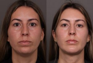 After Image: Deep Neck Contouring with Chin Implant