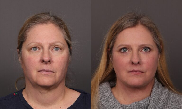 Before Image: Facelift with Upper & Lower Blepharoplasty and Fat Grafting - front
