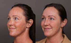 Before Image: BBL Photofacial