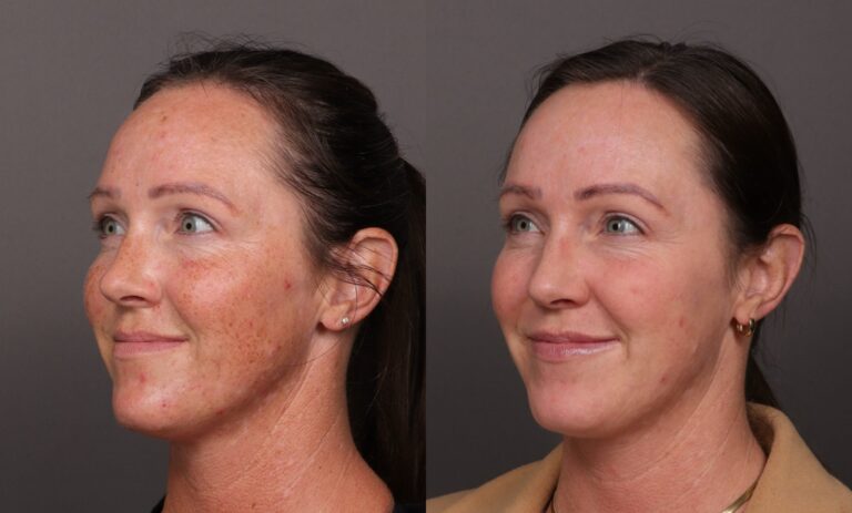 Before Image: BBL Photofacial - front