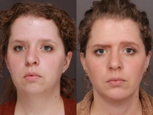 Before Image: Deep Neck Contouring & Chin Implant