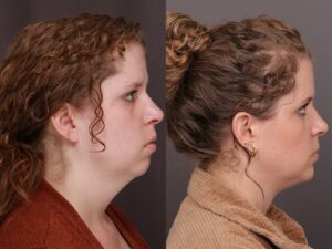 After Image: Deep Neck Contouring & Chin Implant