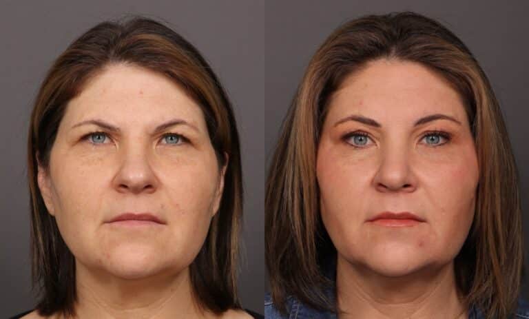 Before Image: Rhinoplasty & Endoscopic Brow lift - front