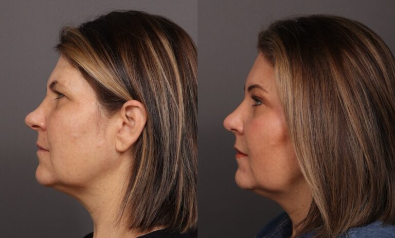 After Image: Rhinoplasty & Endoscopic Brow lift - front