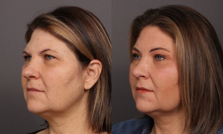After Image: Rhinoplasty & Endoscopic Brow lift - front