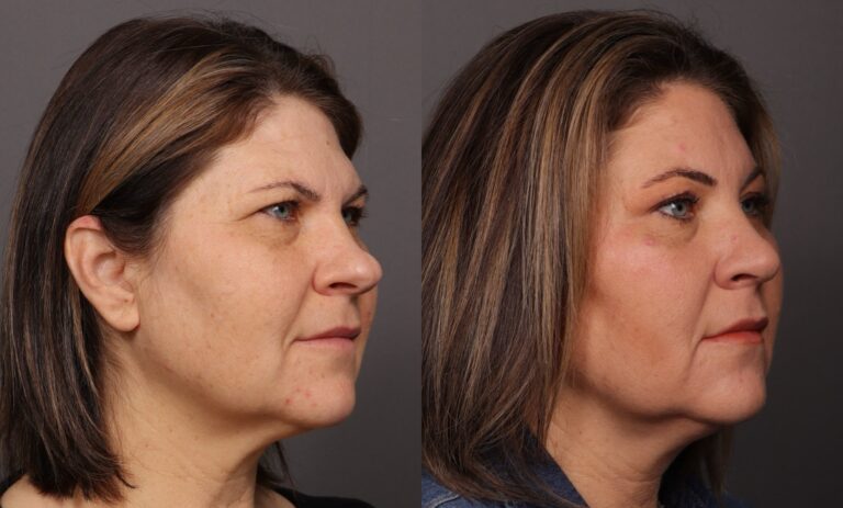 Before Image: Rhinoplasty & Endoscopic Brow lift - front