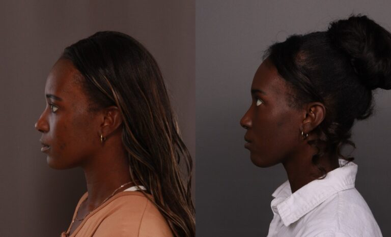 After Image: Bump Shave - front