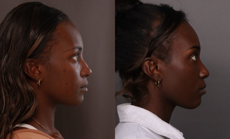 Before Image: Bump Shave - front