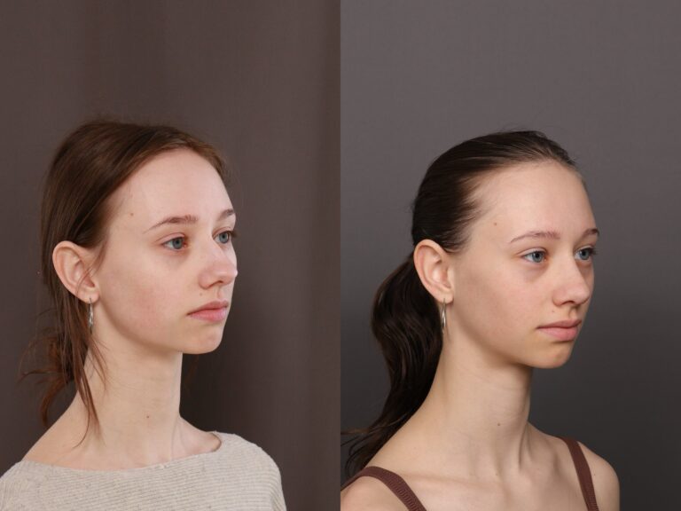 After Image: Rhinoplasty & Bump Shave - front