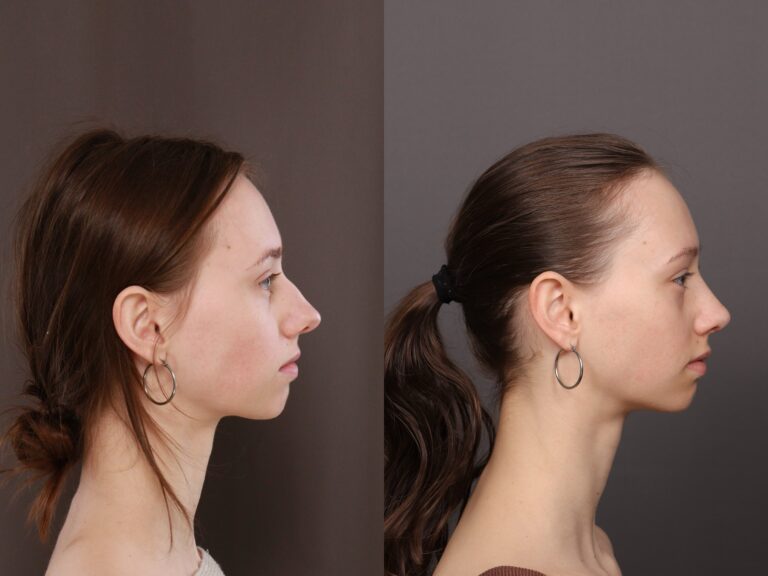 Before Image: Rhinoplasty & Bump Shave - front