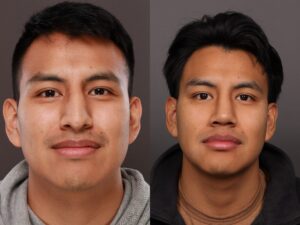 After Image: Rhinoplasty