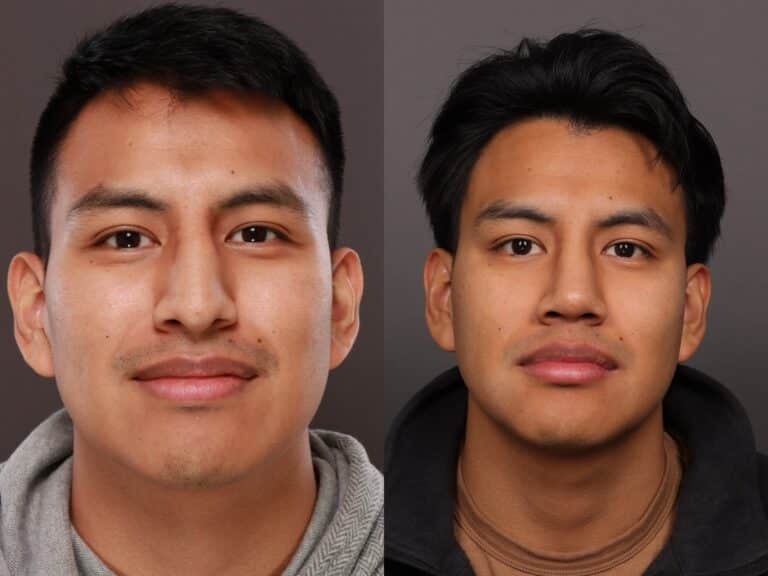 After Image: Rhinoplasty - front