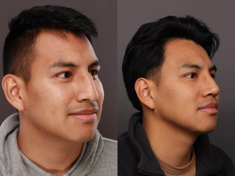 Before Image: Rhinoplasty - front