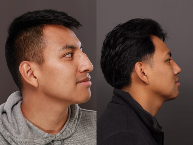 Before Image: Rhinoplasty - 