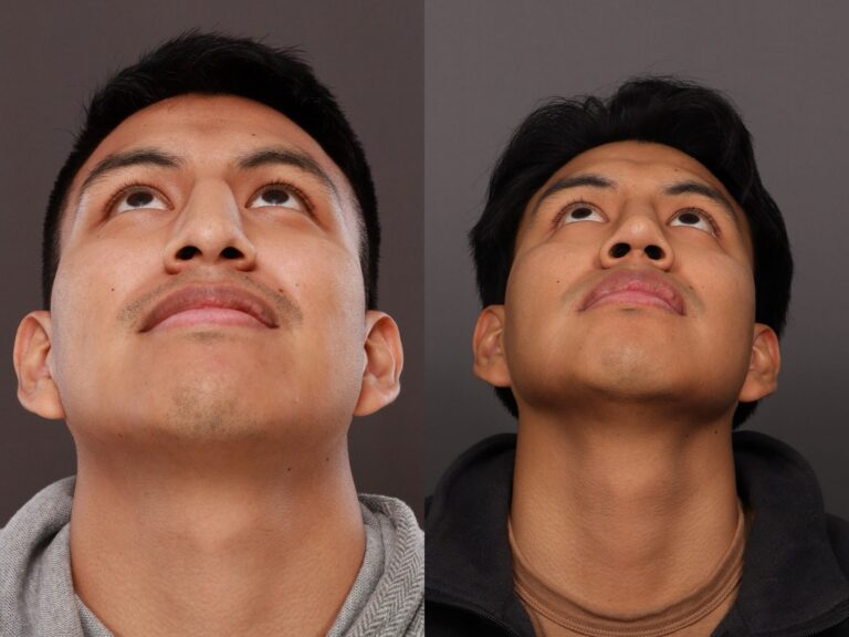 After Image: Rhinoplasty - 