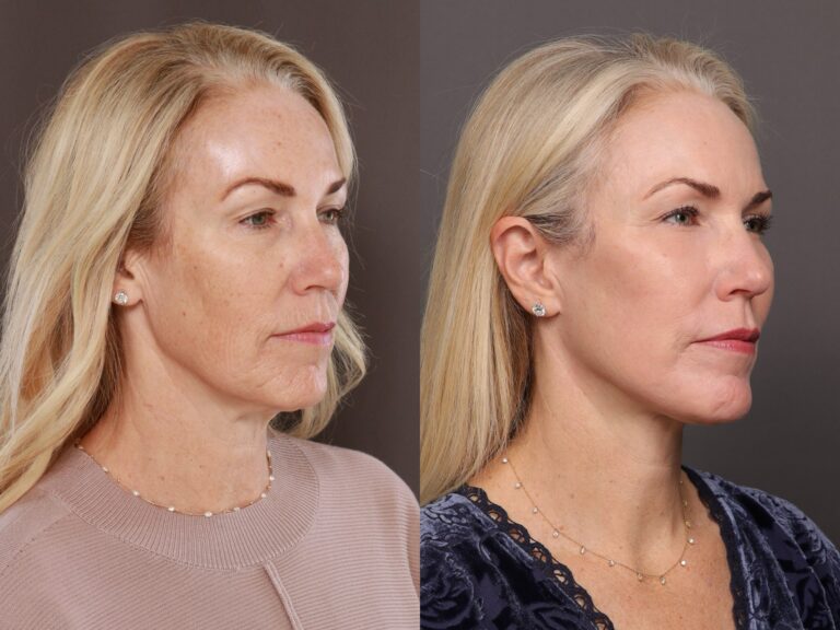 Before Image: Facelift with Lower Blepharoplasty, Fat Grafting & Contour TRL - front