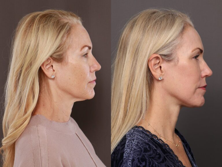 After Image: Facelift with Lower Blepharoplasty, Fat Grafting & Contour TRL - front