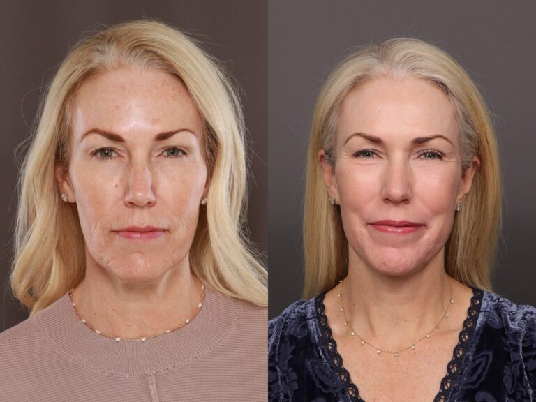 Before Image: Facelift with Lower Blepharoplasty, Fat Grafting & Contour TRL - front