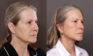 Before Image: Facelift, Upper & Lower Bleph, Chin Implant, Fat Grafting