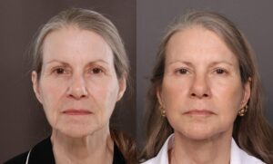 After Image: Facelift, Upper & Lower Bleph, Chin Implant, Fat Grafting