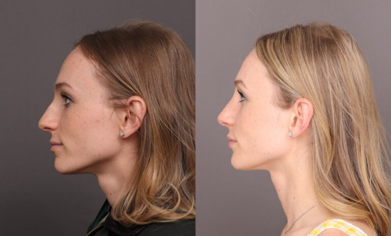 Before Image: Bump Shave - front