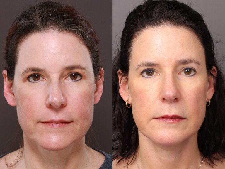 After Image: Lower Face Contouring & Upper Blepharoplasty - 