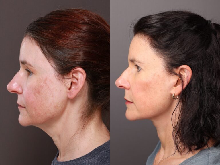 Before Image: Lower Face Contouring & Upper Blepharoplasty - front