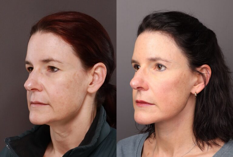 After Image: Lower Face Contouring & Upper Blepharoplasty - front
