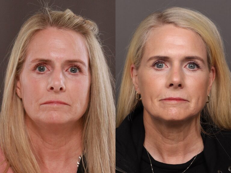 Before Image: Rhinoplasty - front
