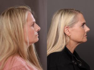 After Image: Rhinoplasty