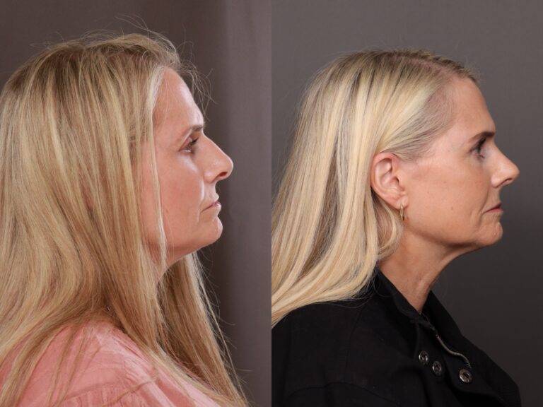 After Image: Rhinoplasty - front
