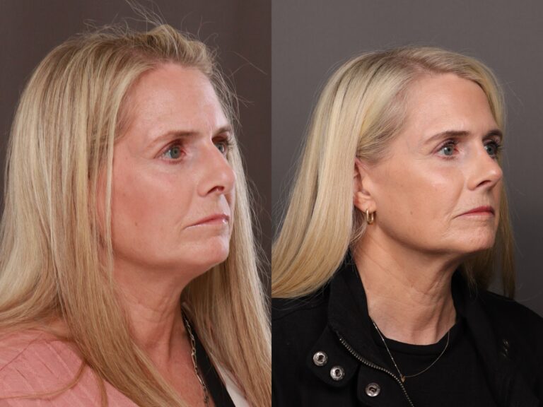 Before Image: Rhinoplasty - 