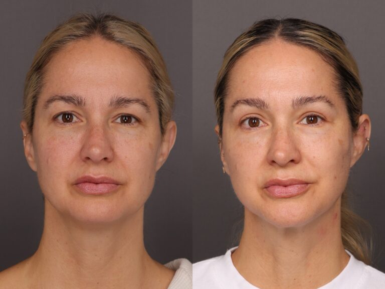 Before Image: MACSlift & Upper Blepharoplasty - front