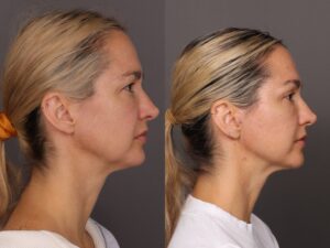 After Image: MACSlift & Upper Blepharoplasty