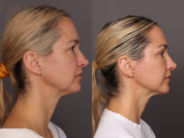 After Image: MACSlift & Upper Blepharoplasty - front