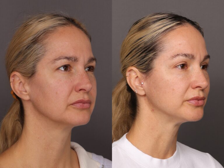 Before Image: MACSlift & Upper Blepharoplasty - 