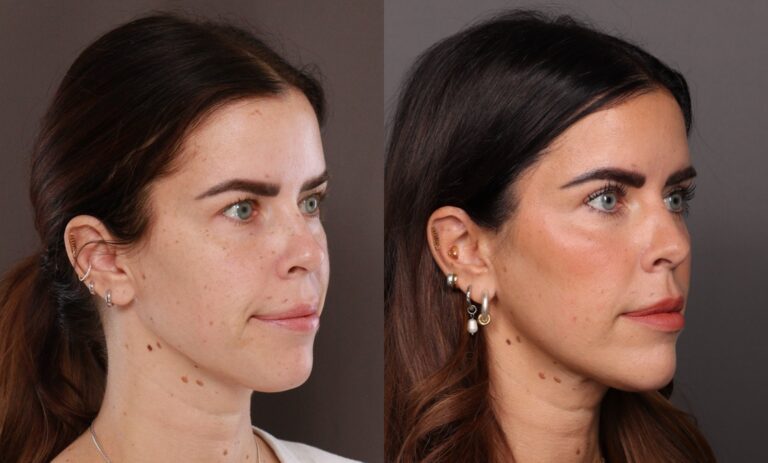 After Image: Upper Blepharoplasty - 