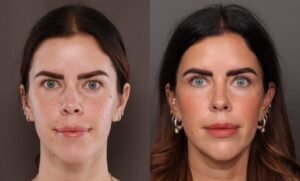 Before Image: Upper Blepharoplasty