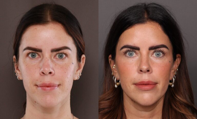 Before Image: Upper Blepharoplasty - front