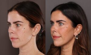 After Image: Upper Blepharoplasty