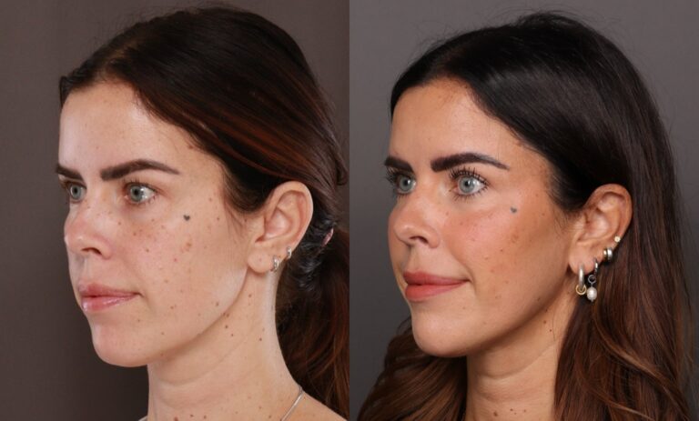 After Image: Upper Blepharoplasty - front