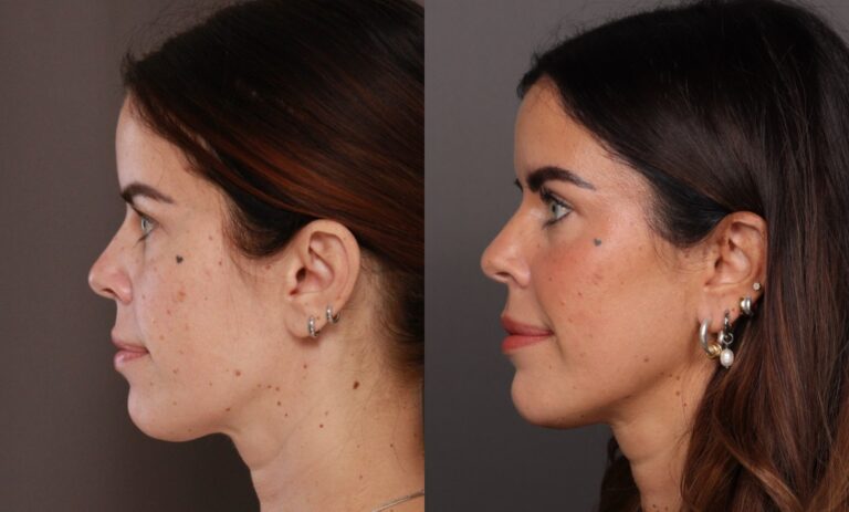 Before Image: Upper Blepharoplasty - 