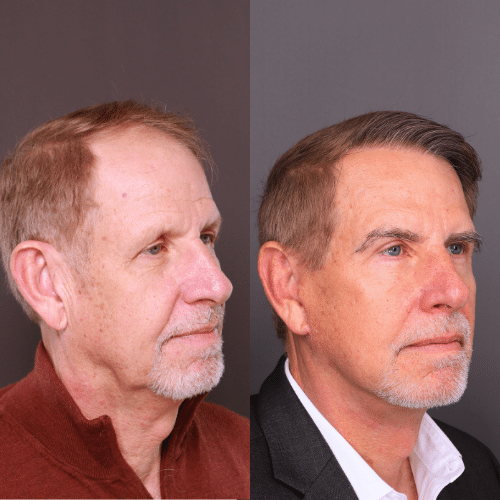 Facelift Before & After 1