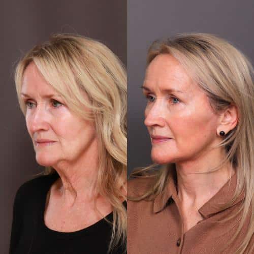 Facelift Before & After