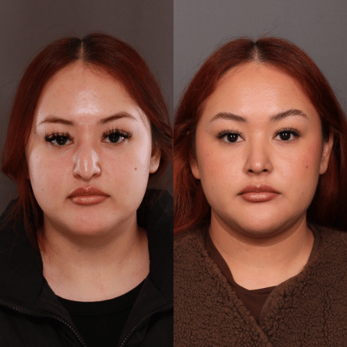 Rhinoplasty Before & After (1)