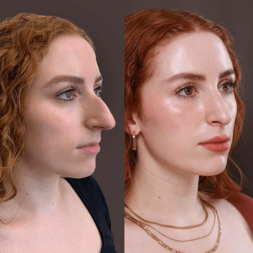 Rhinoplasty Before & After