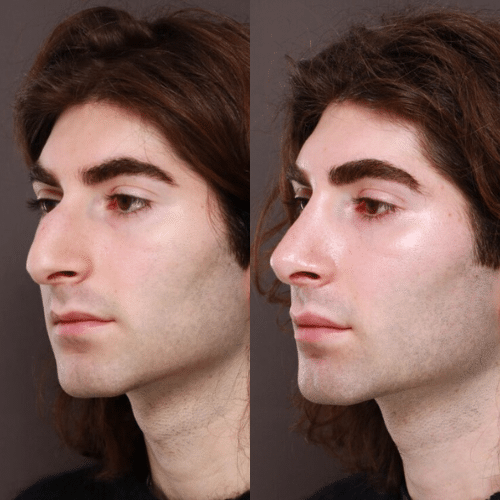 Rhinoplasty Before & After (2)