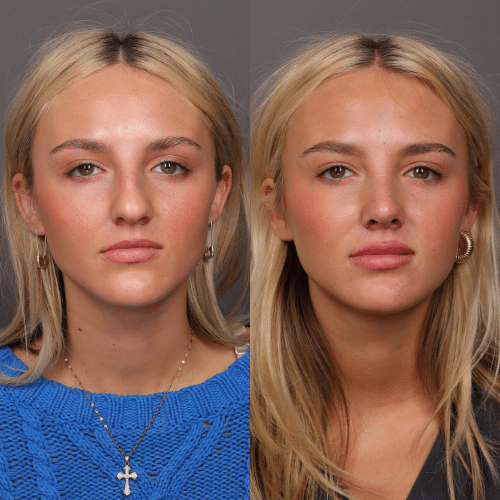 Rhinoplasty Before & After (3)